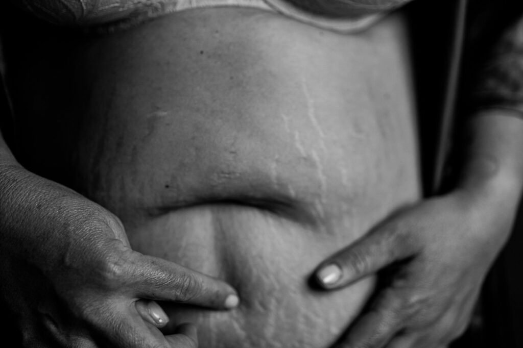 Black and white close-up of a person’s belly with visible stretch marks, wearing a bra. Their hands gently hold and touch the skin, showcasing natural beauty—a style often captured by a Nashville creative portrait photographer.